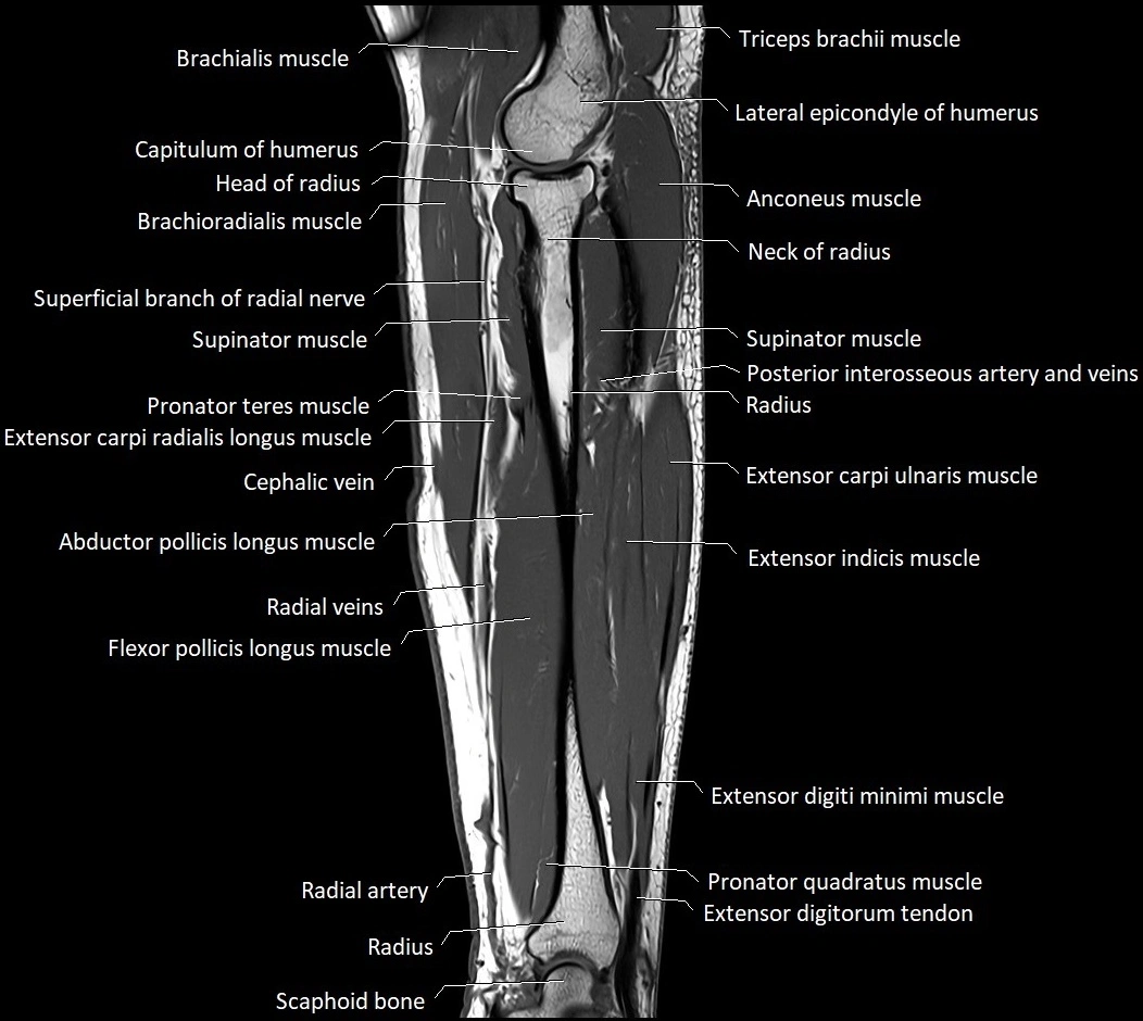 MRI 3T forearm sagittal labelled cross sectional anatomy image 18.webp